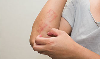 Emolienta, acerca de la piel, dermatitis atópica