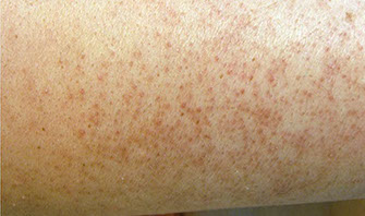 Acerca de la piel, emolienta, queratosis